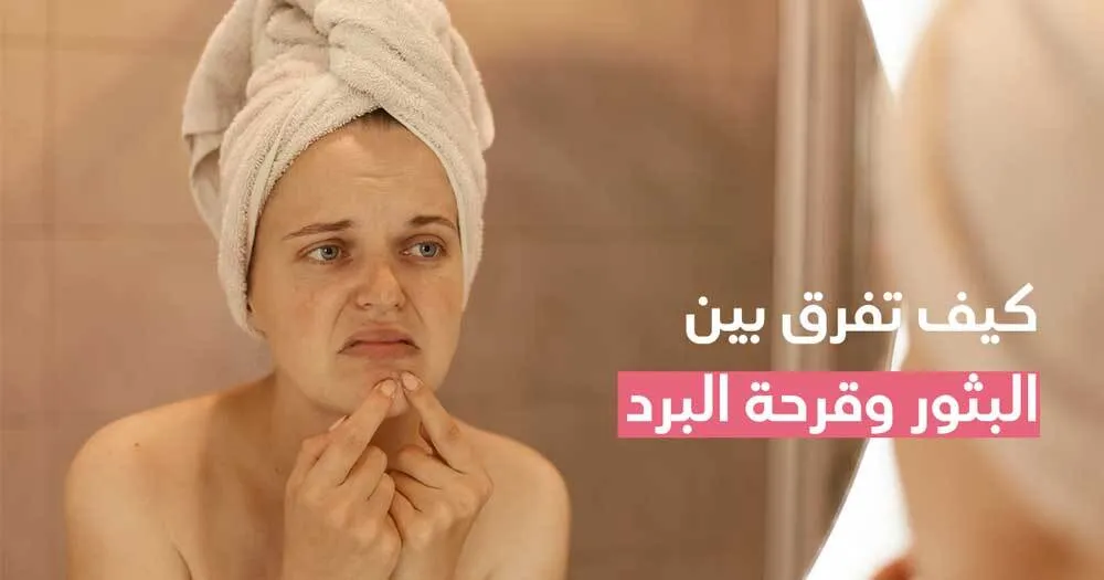 كيف تفرق بين البثور وقرحة البرد